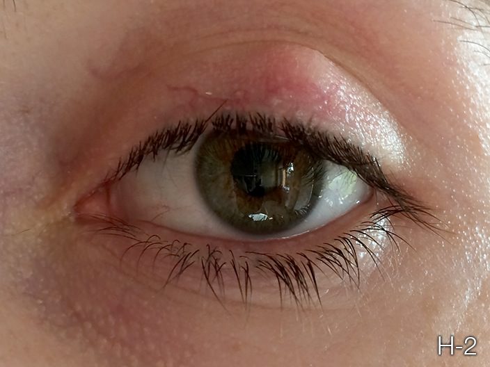 Chalazion surgery step 1